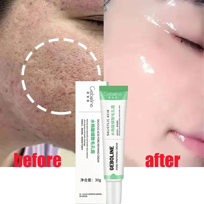 Skincare Salicylic Acid - Ácido Salicílico Poro Shrinking Cream, Eliminação