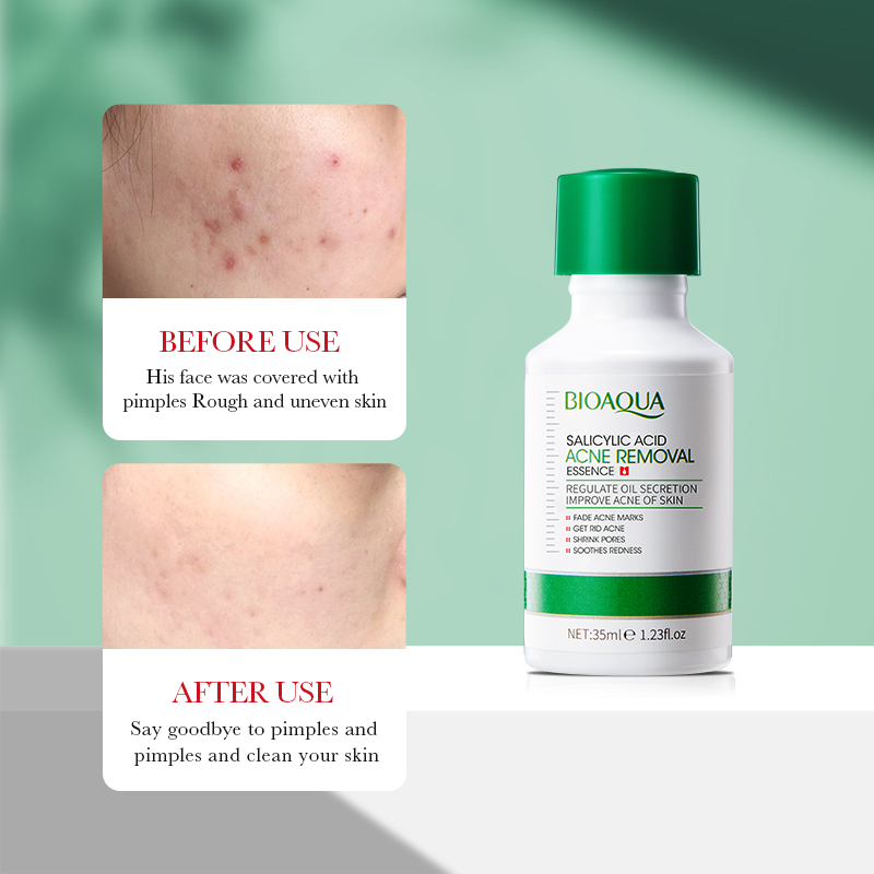35ml bioaoa ácido salicílico a - Tranexamic Acid Serum avaliação e preço