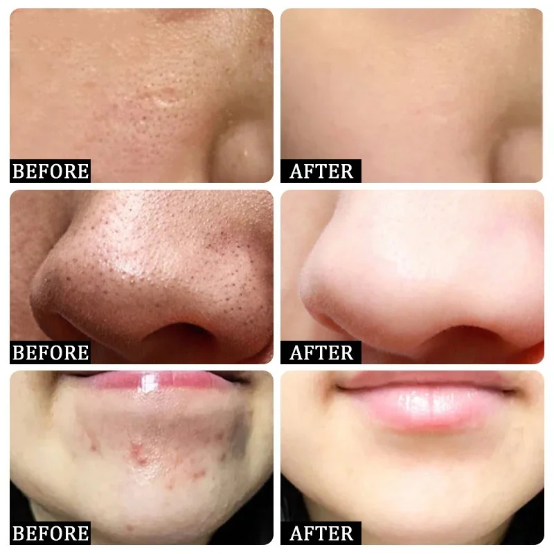 Ácido salicílico poros limpeza - Skincare Salicylic Acid avaliação e preço