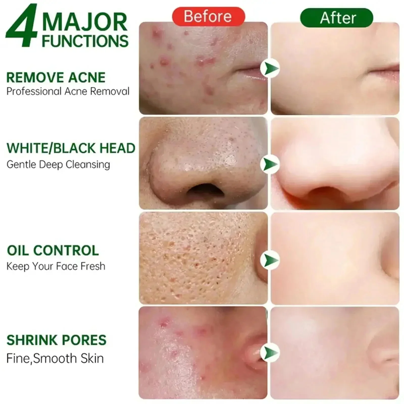 Ácido salicílico poros limpeza - Skincare Salicylic Acid avaliação e preço