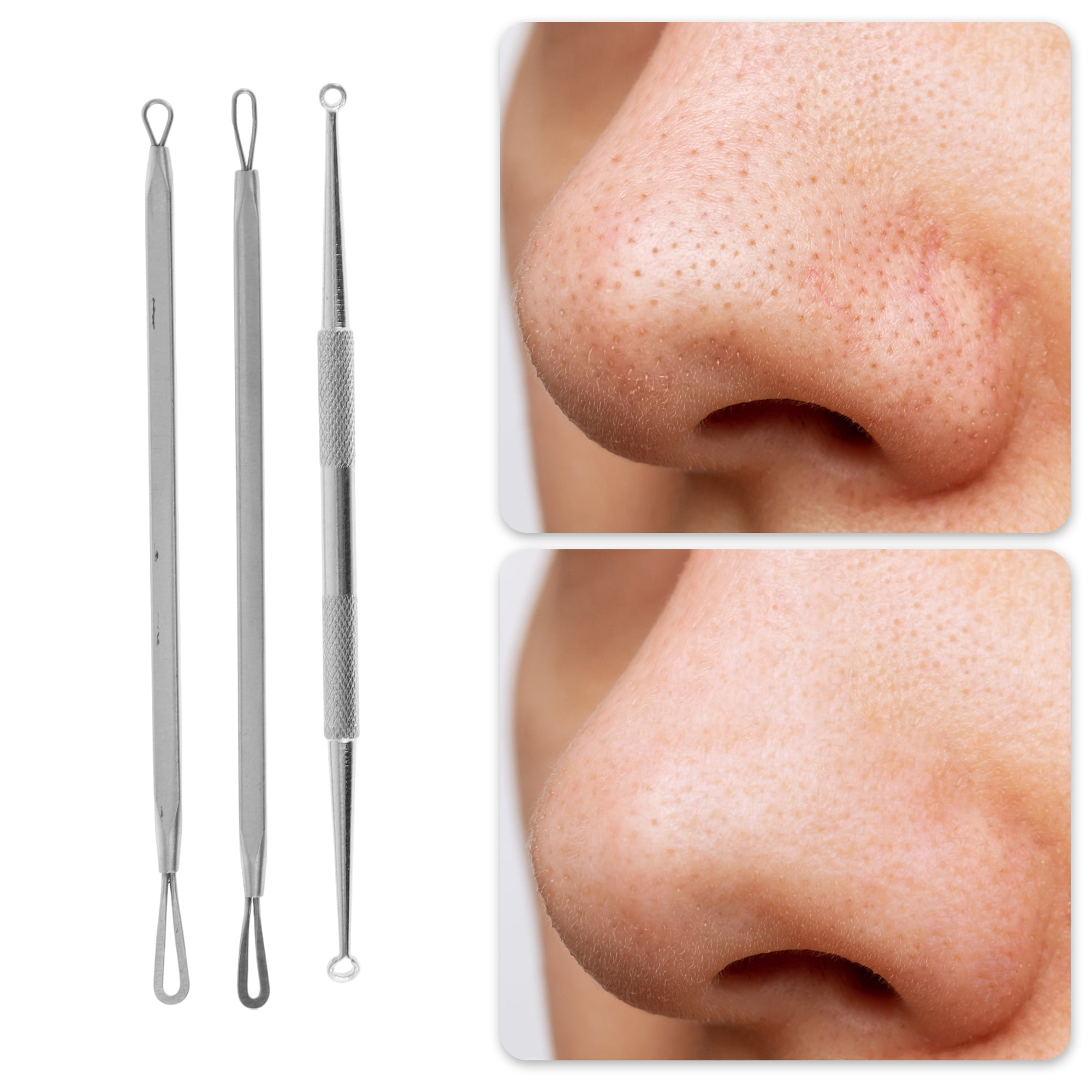 Kit Profissional Extrator de C - Skincare Acne avaliação e preço